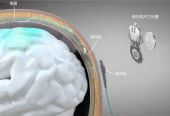 脑机接口植入物故障，会导致人脑残吗？